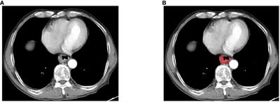 A radiomics nomogram for predicting postoperative recurrence in esophageal squamous cell carcinoma